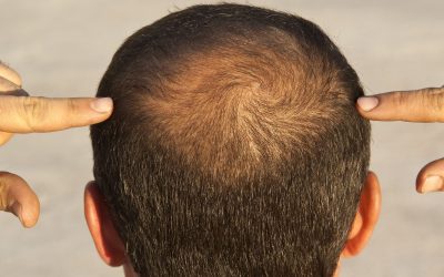 ¿La ceto causa caída del cabello?