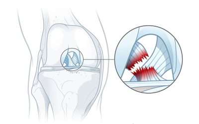 Detección de rodilla: integración del entrenamiento de rendimiento con conocimientos clínicos